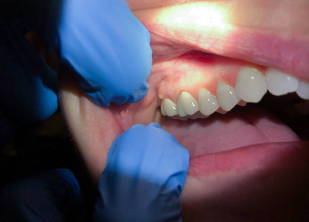 Best Emergency Root Canal Treatment in South Brooksville, FL
